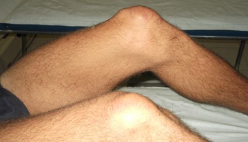 Sindrome femoro-rotulea e appoggio plantare: analisi dell’appoggio per progetto del plantare